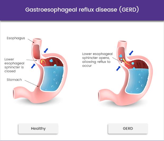 Healthy stomach vs GERD