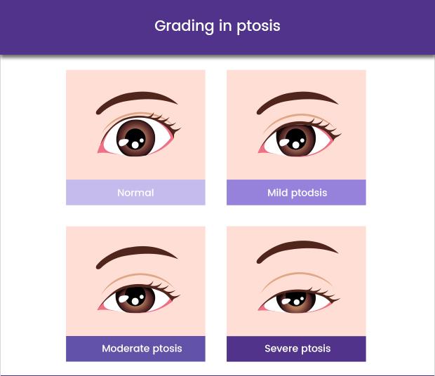 Graphic showing a grading in ptosis
