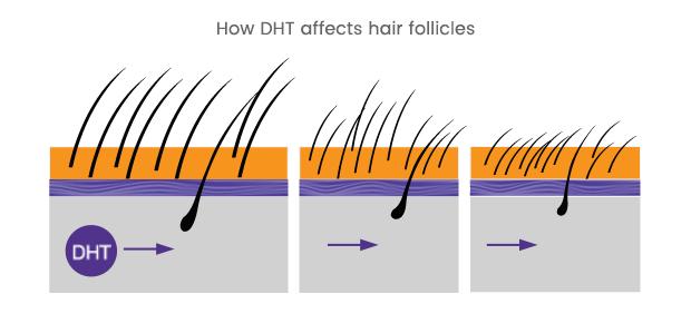 Graphic showing how elevated DHT levels affects hair growth