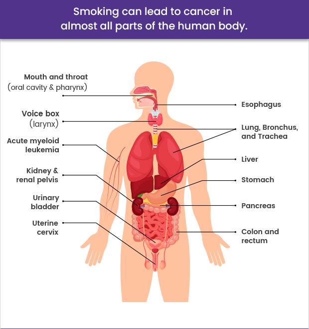 Smoking can lead to cancer in almost all parts of the human body.