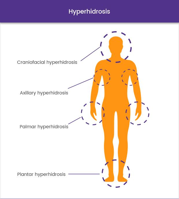 graphic showing areas where hyperhidrosis commonly occurs